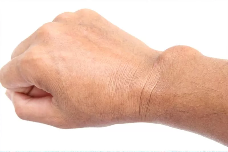 Ganglion Cysts Ganglion Cysts